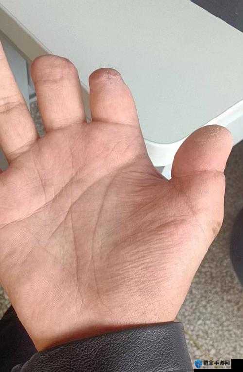 一根手指头喊疼意味着什么：探究疼痛感知的复杂性