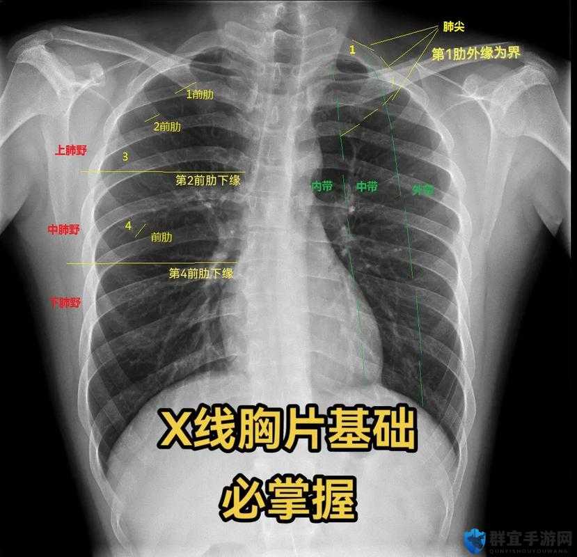 100%胸片曝光率软件：助力医疗影像精准呈现的利器