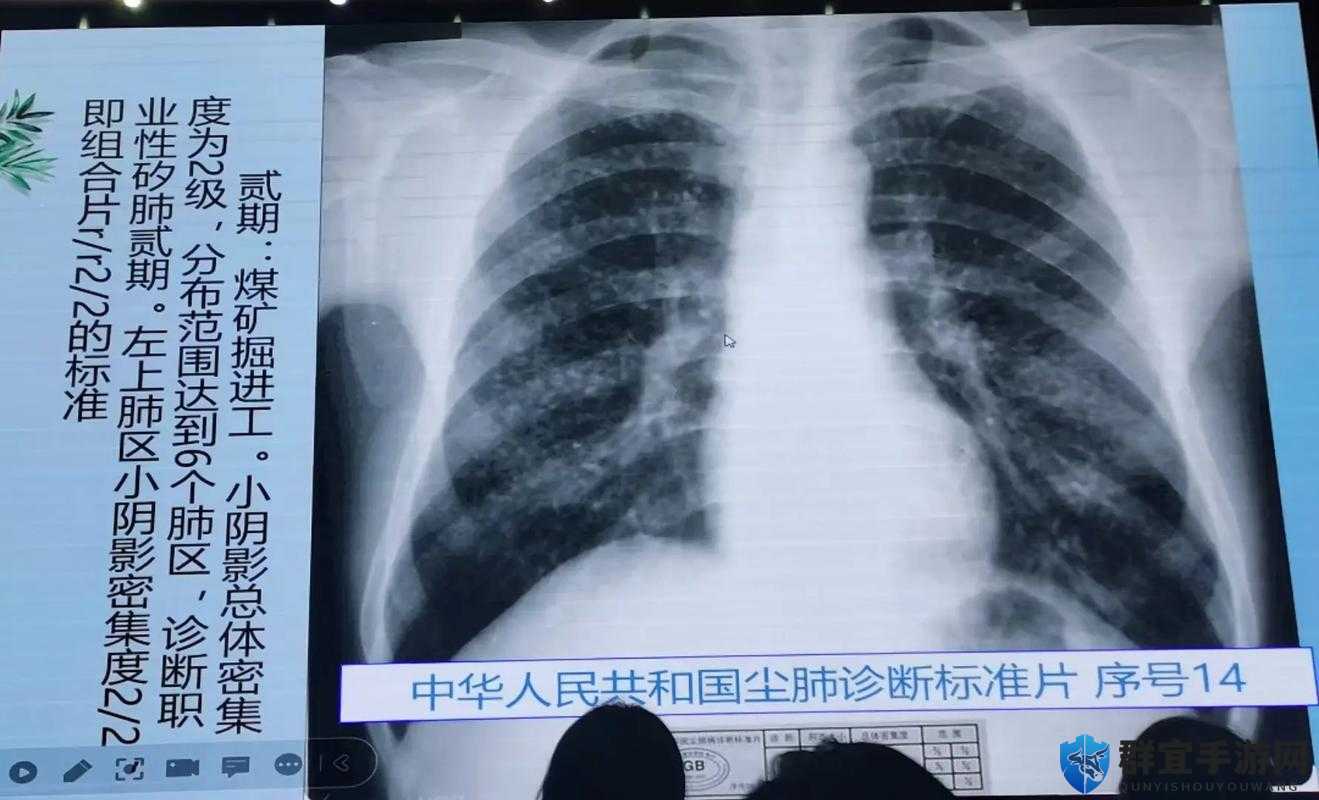 100%胸片曝光率与曝光率 2024:对医疗诊断的重要意义与影响